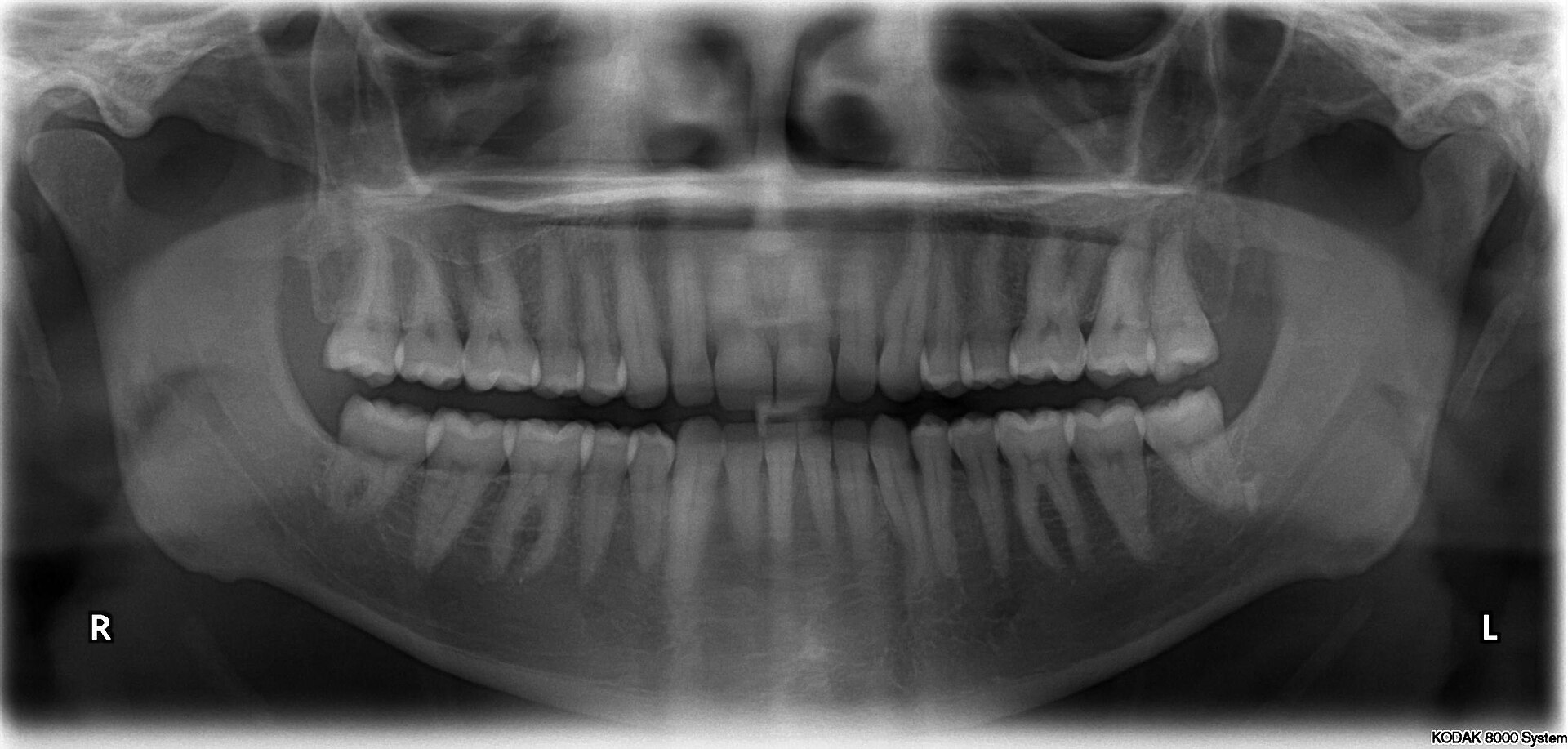 Radiografía panorámica real de una dentadura completa